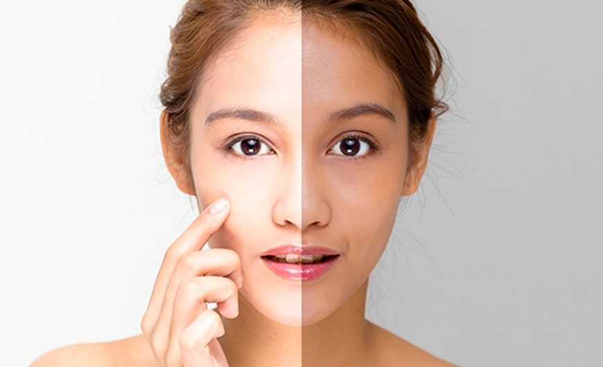 Explore All Options With Skin Whitening Solutions Now